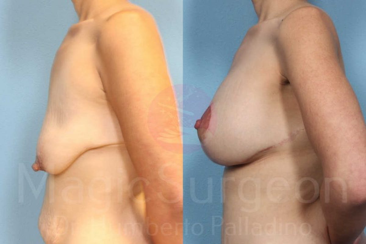Breast Lift Before & After Gallery - Patient 133182422 - Image 3