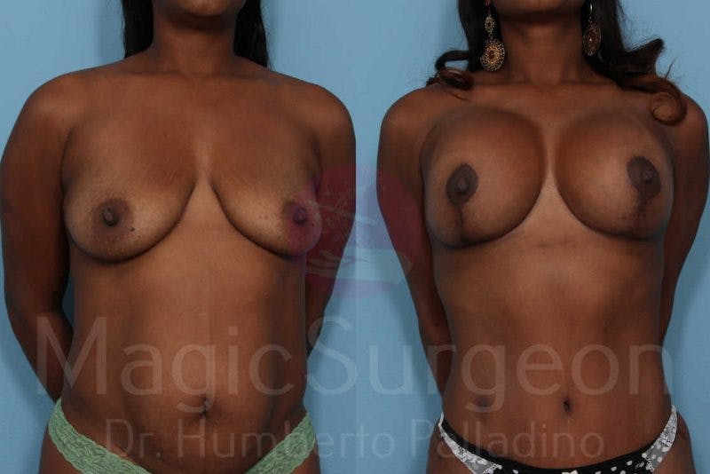 Breast Lift Before & After Gallery - Patient 133182423 - Image 1