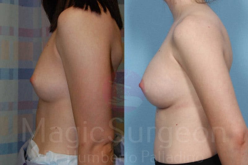Breast Augmentation Before & After Gallery - Patient 133182424 - Image 3