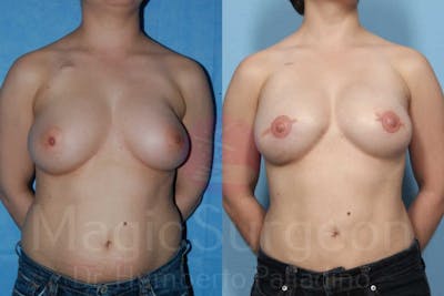 Breast Reconstruction Before & After Gallery - Patient 133182425 - Image 1