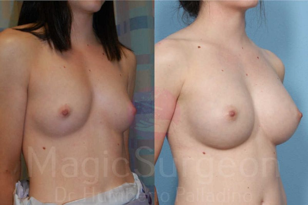 Breast Augmentation Before & After Gallery - Patient 133182424 - Image 4