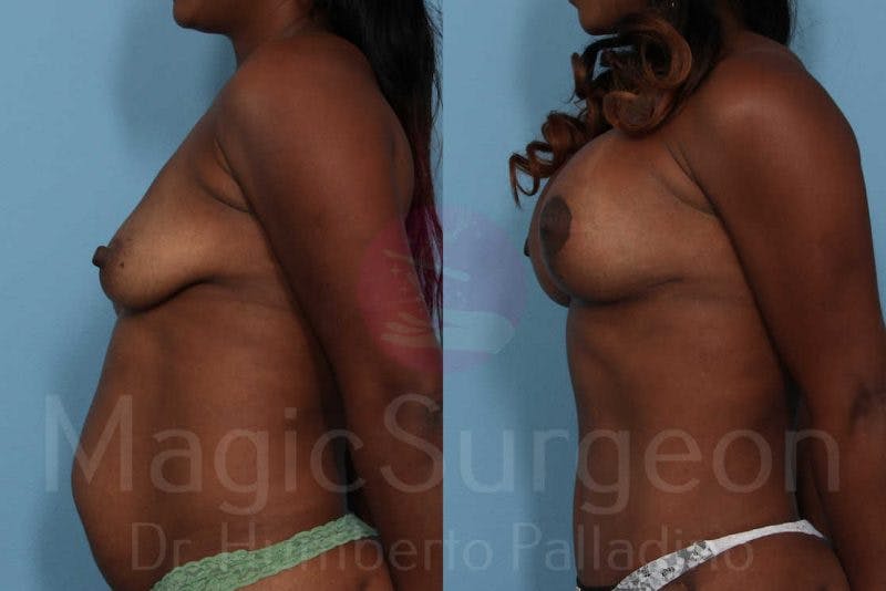 Breast Lift Before & After Gallery - Patient 133182423 - Image 3