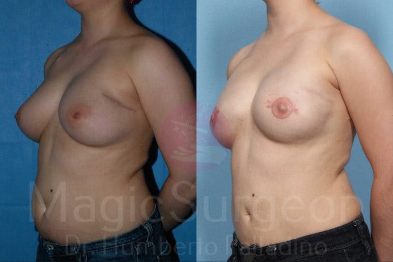 Breast Reconstruction Before & After Gallery - Patient 133182425 - Image 2