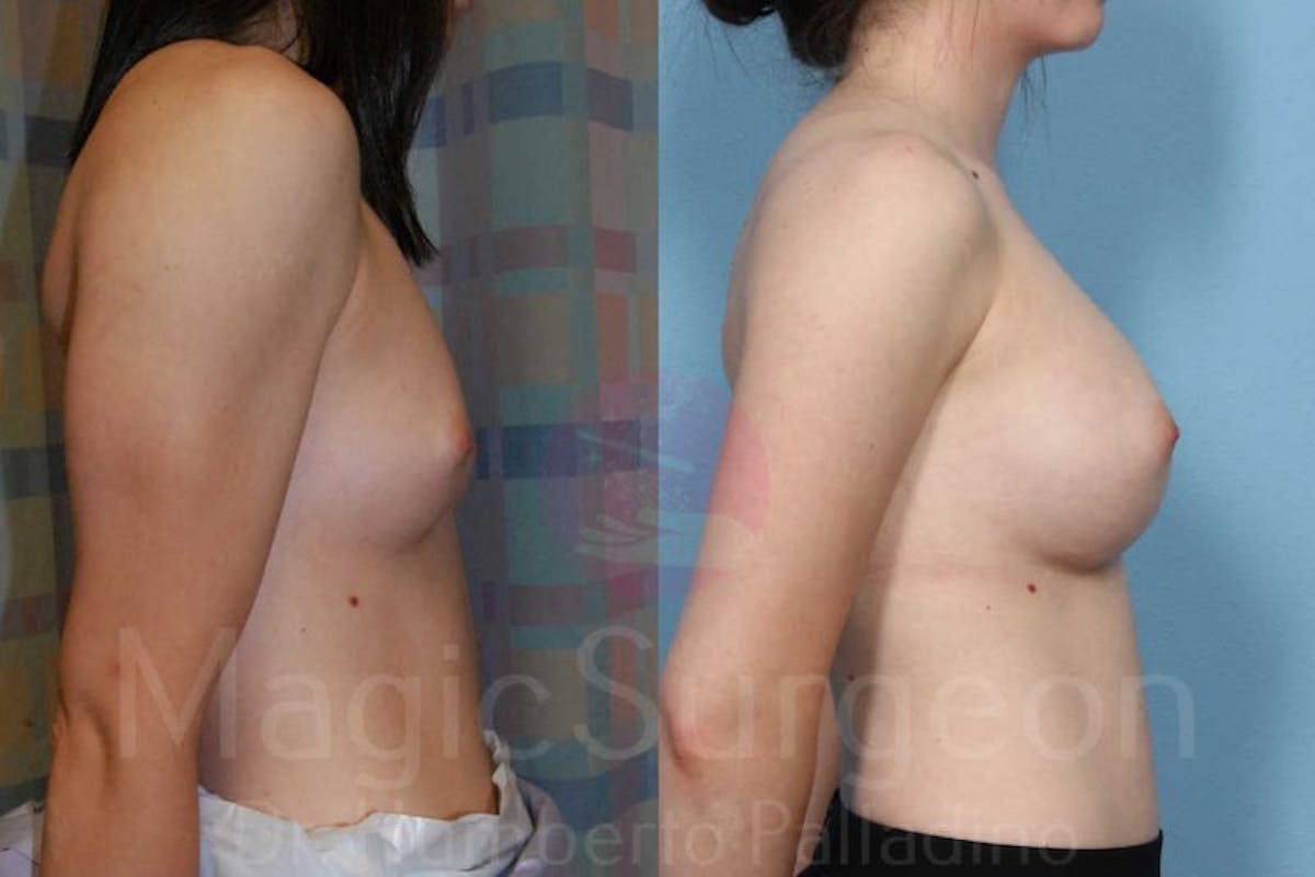 Breast Augmentation Before & After Gallery - Patient 133182424 - Image 5
