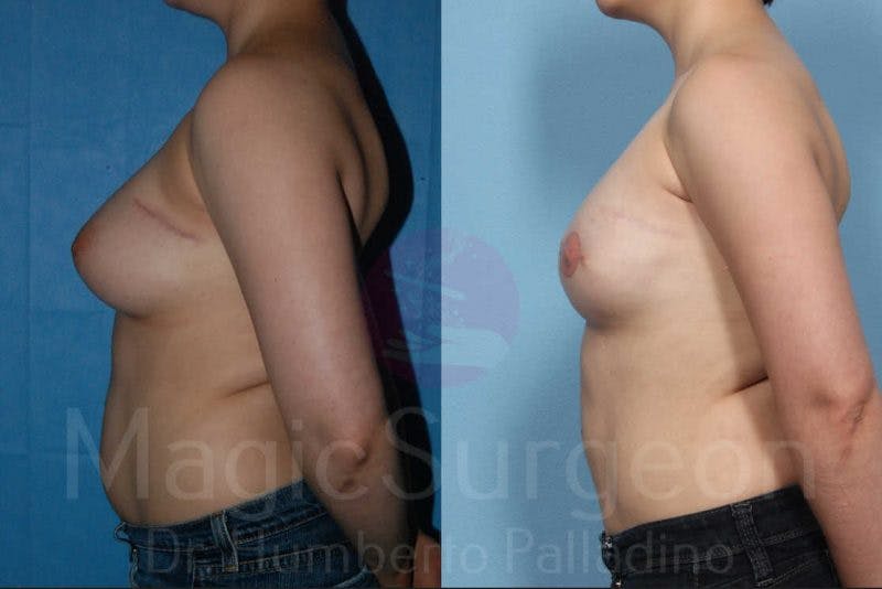 Breast Reconstruction Before & After Gallery - Patient 133182425 - Image 3