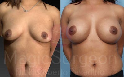Breast Augmentation Before & After Gallery - Patient 133182427 - Image 1