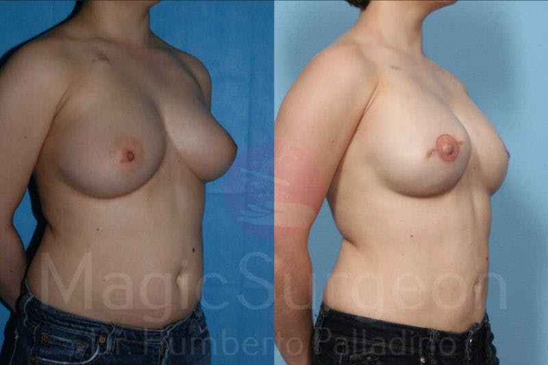 Breast Reconstruction Before & After Gallery - Patient 133182425 - Image 4