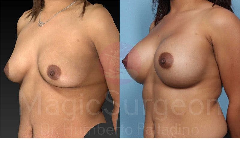 Breast Augmentation Before & After Gallery - Patient 133182427 - Image 2