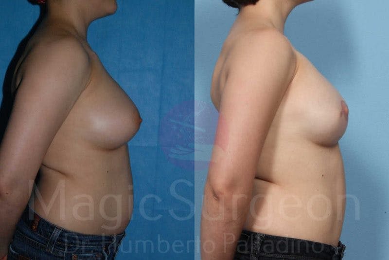 Breast Reconstruction Before & After Gallery - Patient 133182425 - Image 5