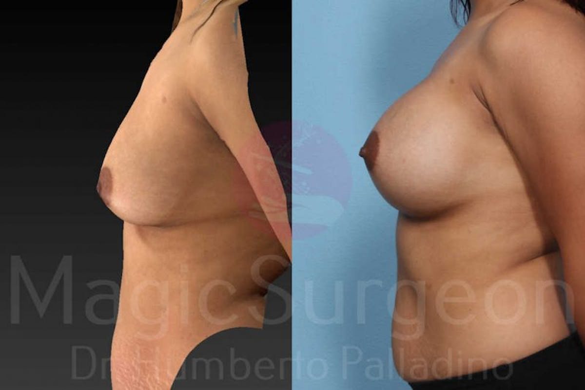 Breast Augmentation Before & After Gallery - Patient 133182427 - Image 3