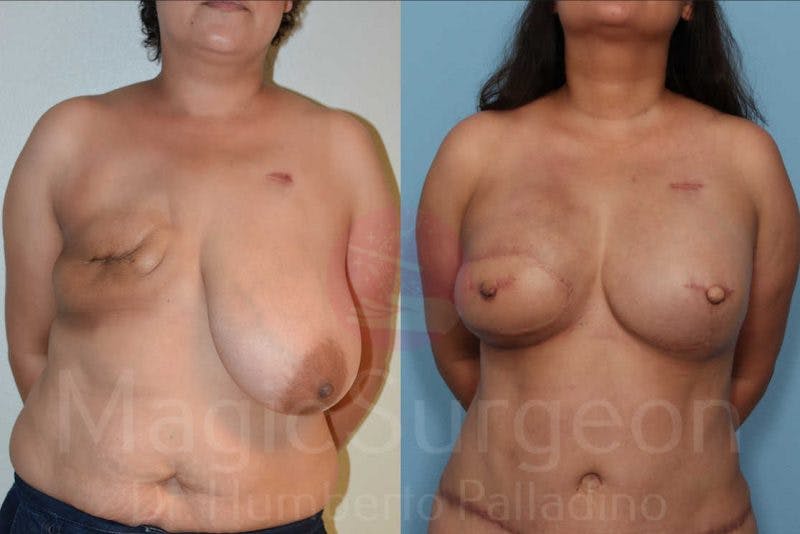 Breast Reconstruction Before & After Gallery - Patient 133182428 - Image 1