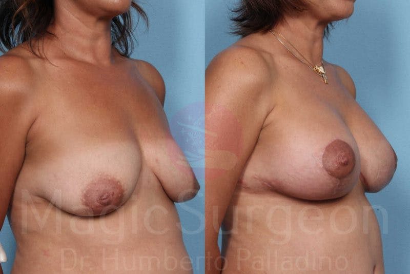 Breast Lift Before & After Gallery - Patient 133182426 - Image 4