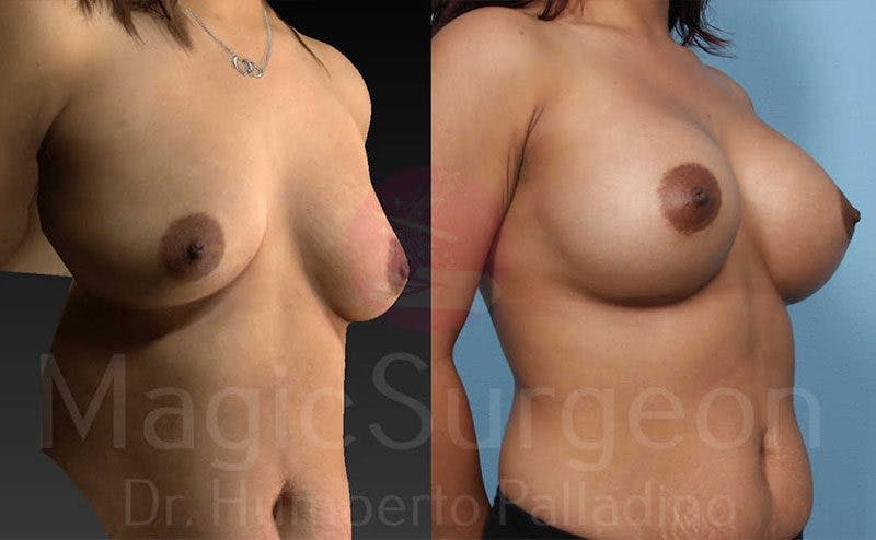 Breast Augmentation Before & After Gallery - Patient 133182427 - Image 4