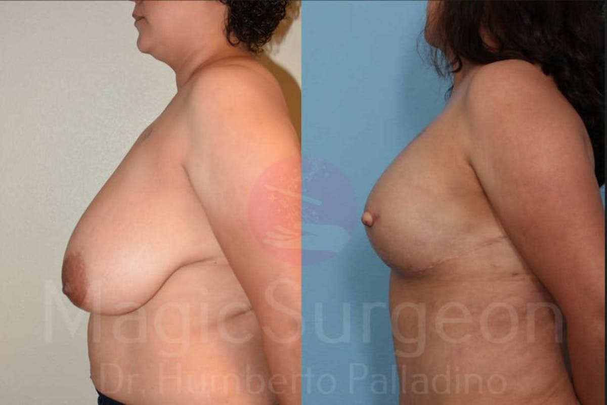 Breast Reconstruction Before & After Gallery - Patient 133182428 - Image 2