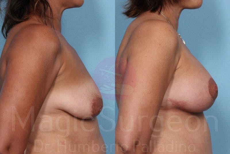 Breast Lift Before & After Gallery - Patient 133182426 - Image 5