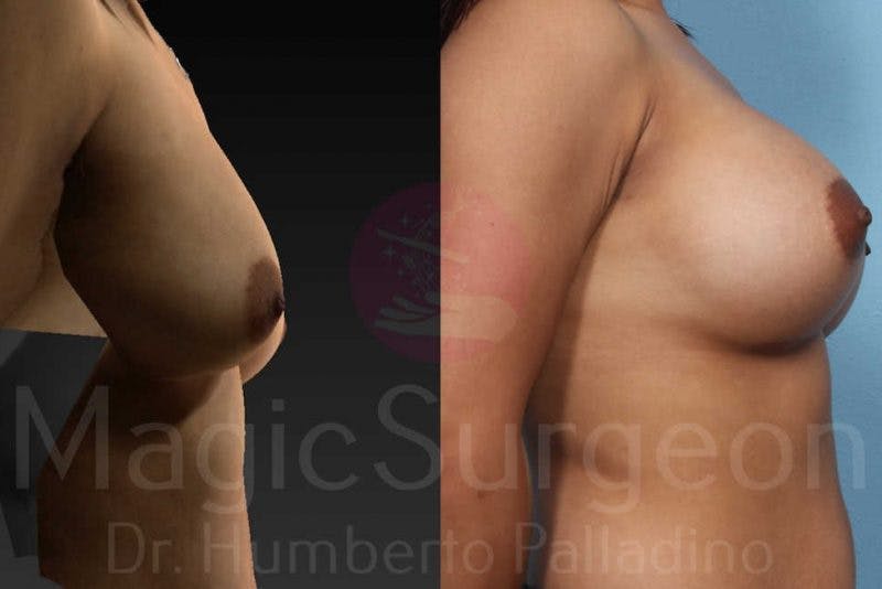 Breast Augmentation Before & After Gallery - Patient 133182427 - Image 5