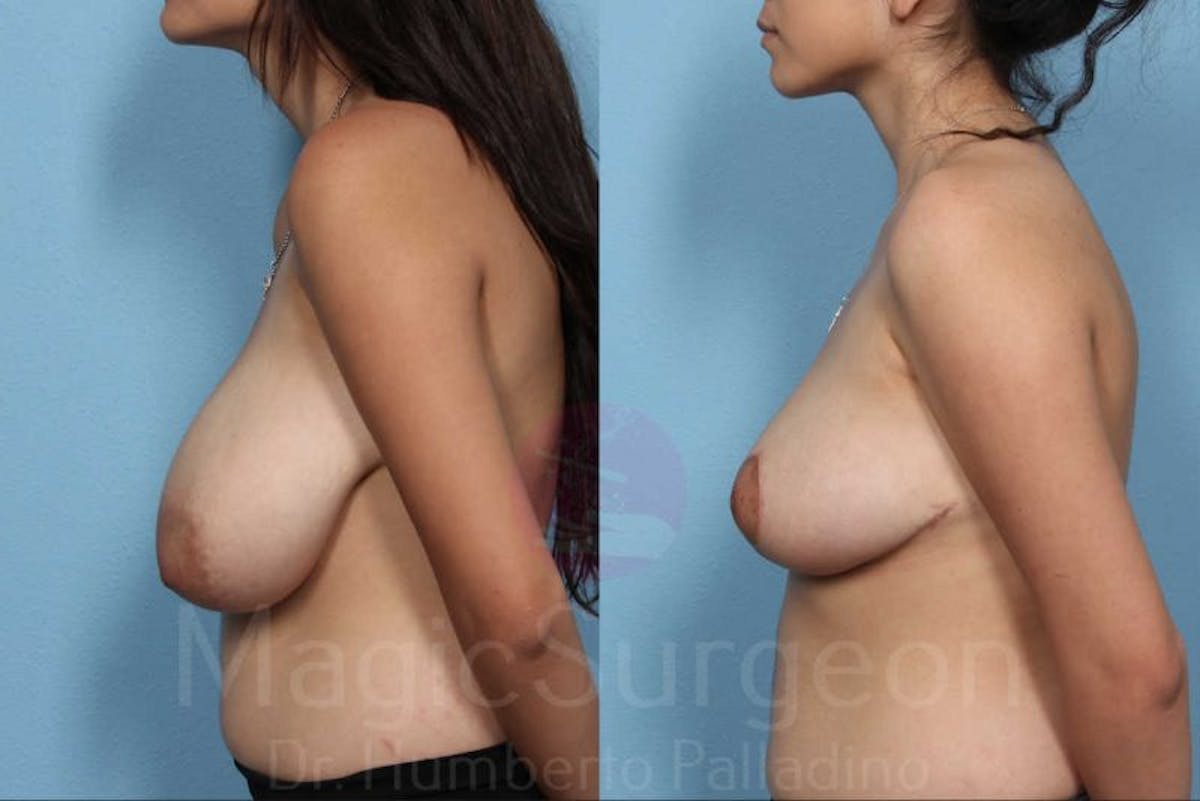 Breast Reduction Before & After Gallery - Patient 133182429 - Image 3