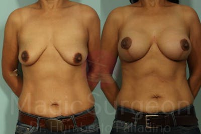 Breast Lift Before & After Gallery - Patient 133182430 - Image 1