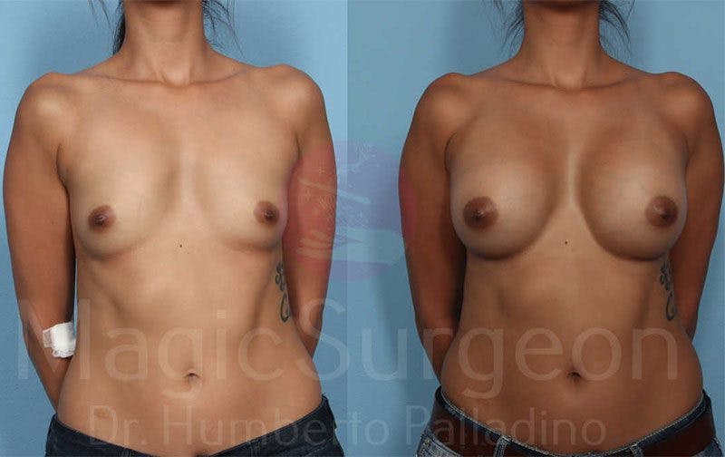 Breast Augmentation Before & After Gallery - Patient 133182431 - Image 1