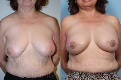 Breast Reconstruction Before & After Gallery - Patient 133182432 - Image 1