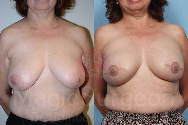 Breast Reconstruction Before & After Gallery - Patient 133182432 - Image 1