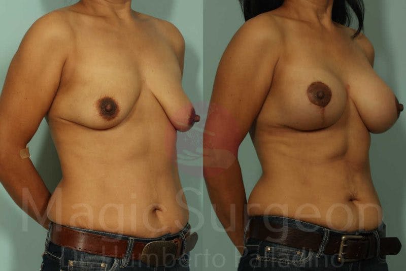 Breast Lift Before & After Gallery - Patient 133182430 - Image 2