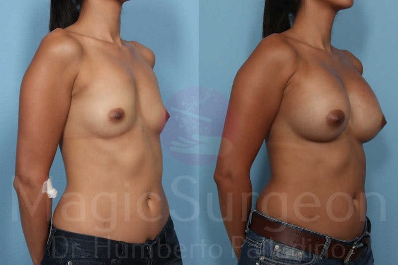 Breast Augmentation Before & After Gallery - Patient 133182431 - Image 2