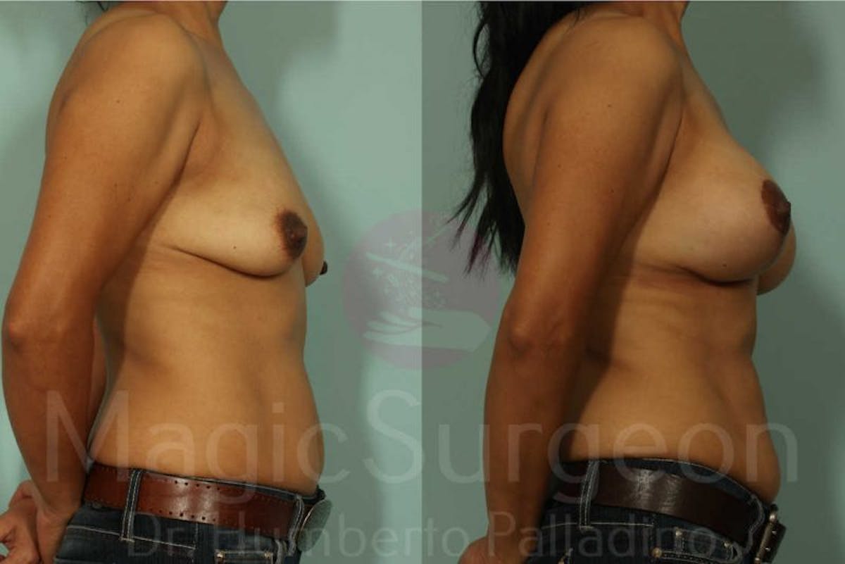 Breast Lift Before & After Gallery - Patient 133182430 - Image 3