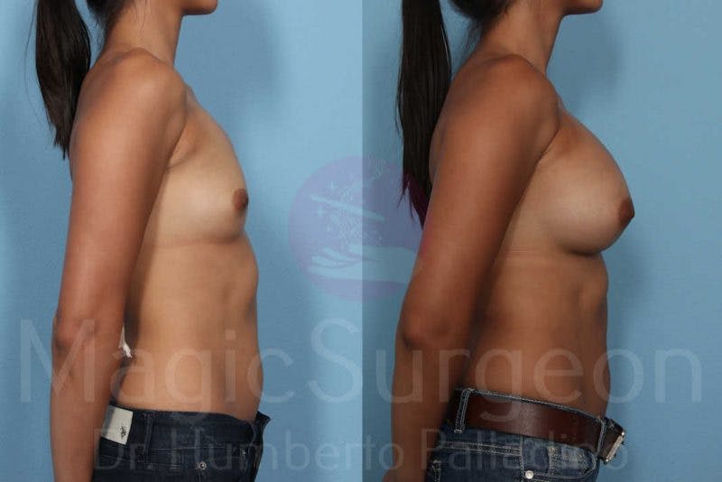 Breast Augmentation Before & After Gallery - Patient 133182431 - Image 3