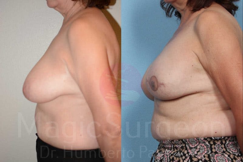 Breast Reconstruction Before & After Gallery - Patient 133182432 - Image 3