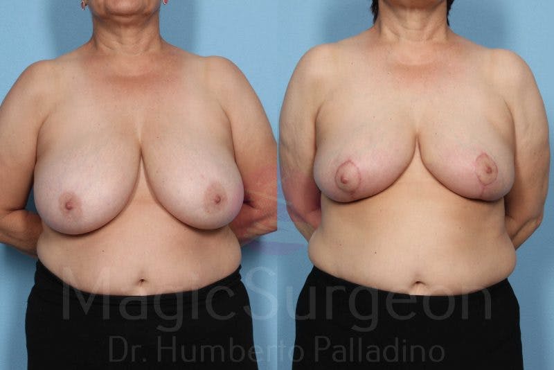 Breast Reduction Before & After Gallery - Patient 133182435 - Image 1