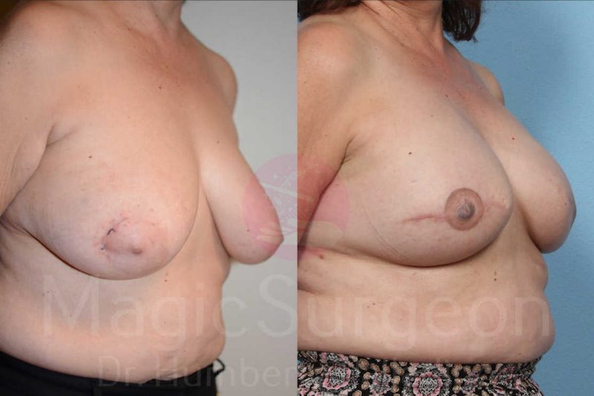 Breast Reconstruction Before & After Gallery - Patient 133182432 - Image 4