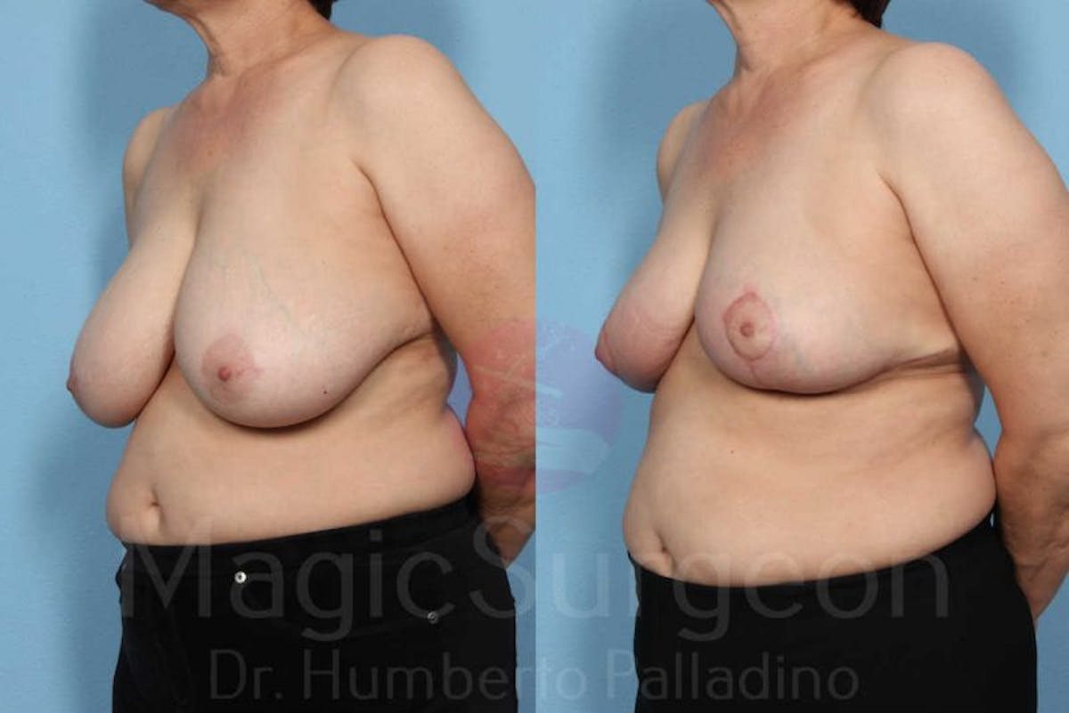 Breast Reduction Before & After Gallery - Patient 133182435 - Image 2