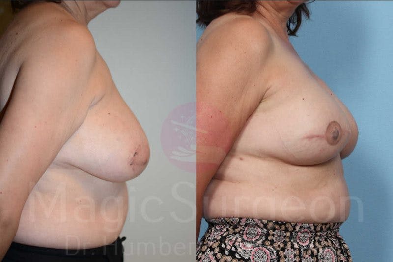 Breast Reconstruction Before & After Gallery - Patient 133182432 - Image 5