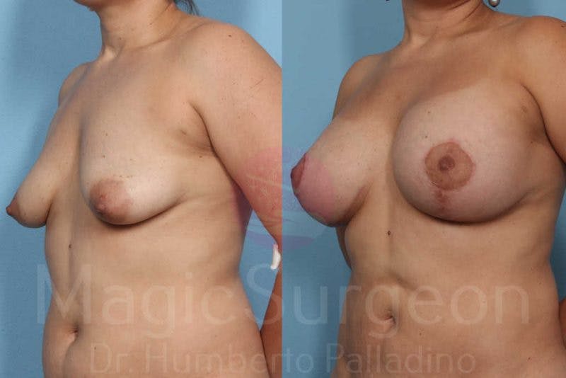 Breast Lift Before & After Gallery - Patient 133182434 - Image 2