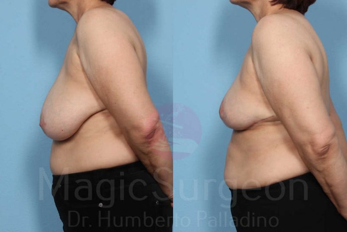 Breast Reduction Before & After Gallery - Patient 133182435 - Image 3