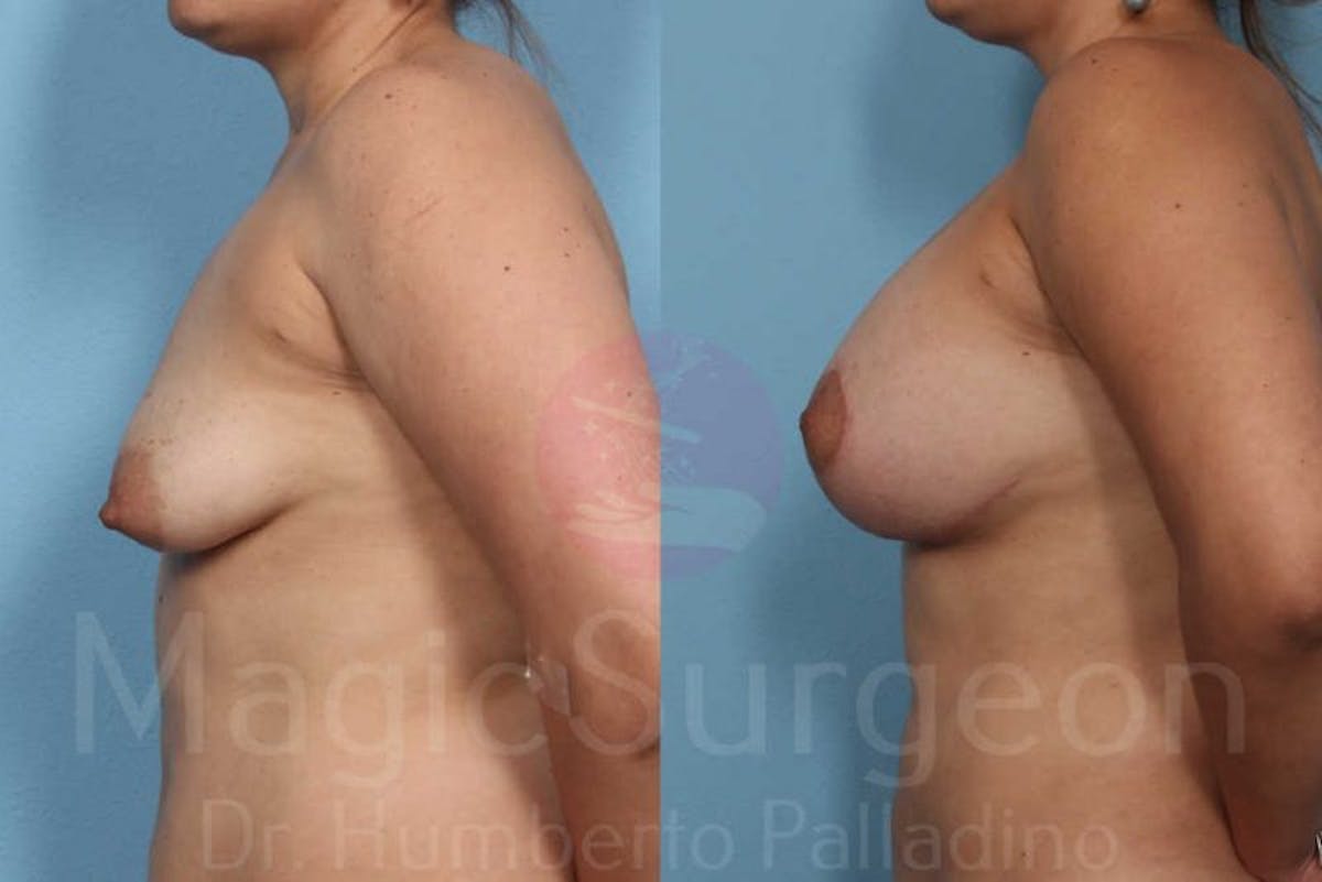 Breast Lift Before & After Gallery - Patient 133182434 - Image 3