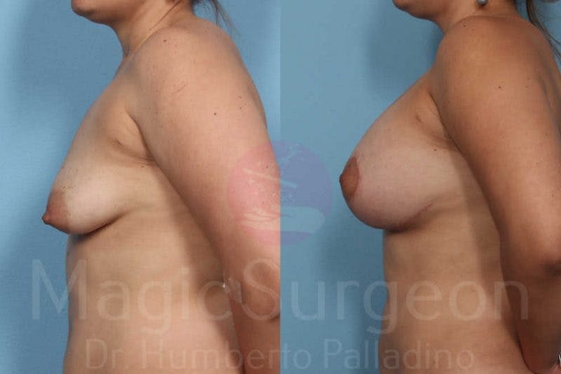 Breast Lift Before & After Gallery - Patient 133182434 - Image 3