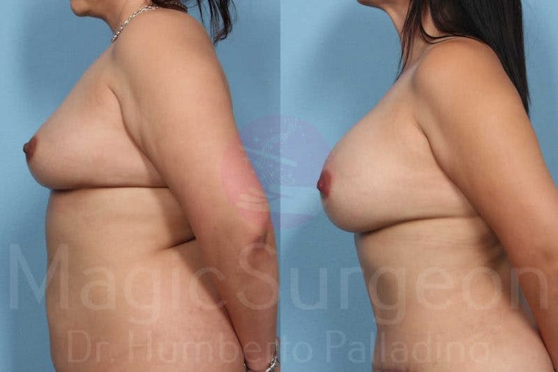 Breast Augmentation Before & After Gallery - Patient 133182433 - Image 3