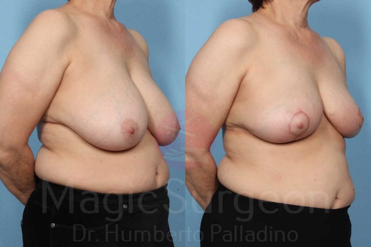 Breast Reduction Before & After Gallery - Patient 133182435 - Image 4