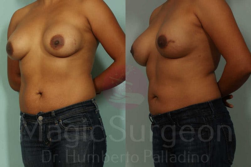Breast Reconstruction Before & After Gallery - Patient 133182437 - Image 2