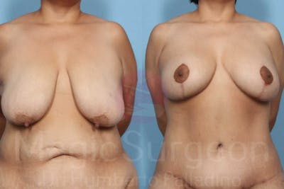 Breast Lift Before & After Gallery - Patient 133182438 - Image 1