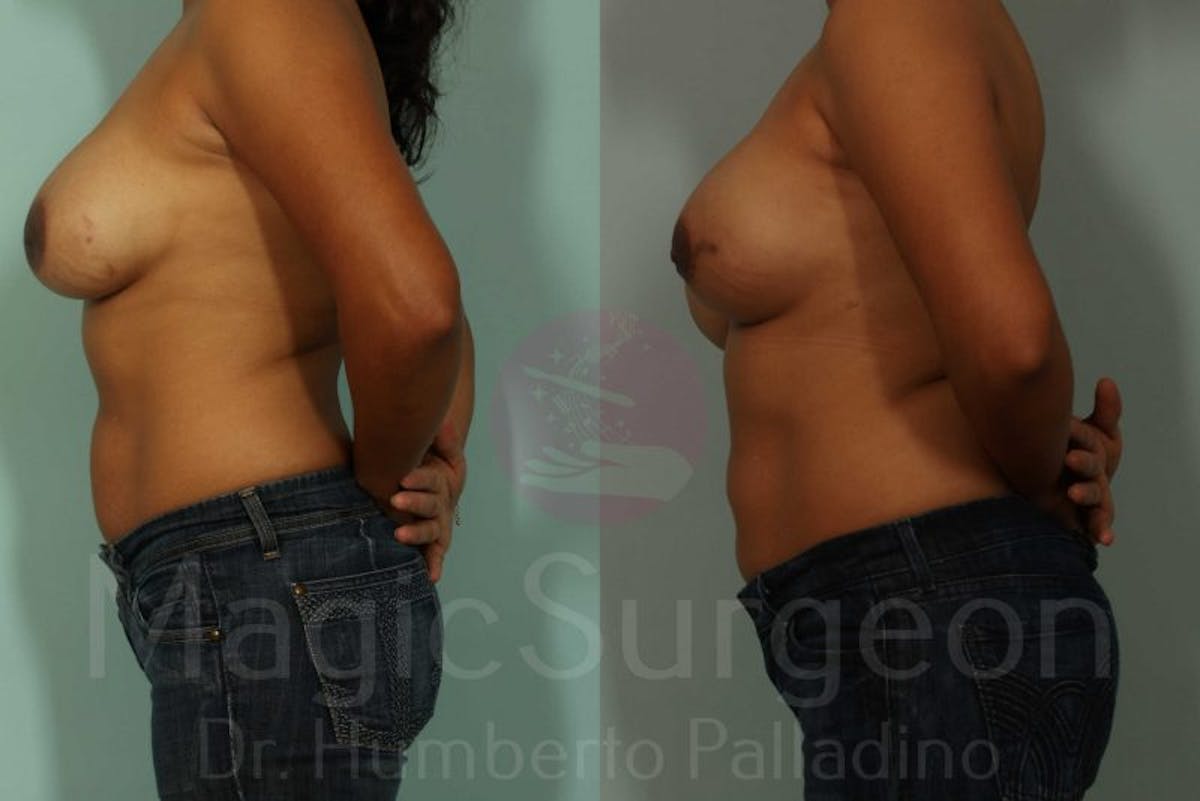 Breast Reconstruction Before & After Gallery - Patient 133182437 - Image 3