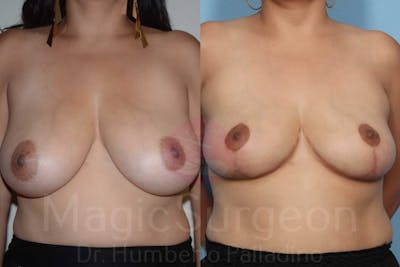 Breast Reduction Before & After Gallery - Patient 133182440 - Image 1