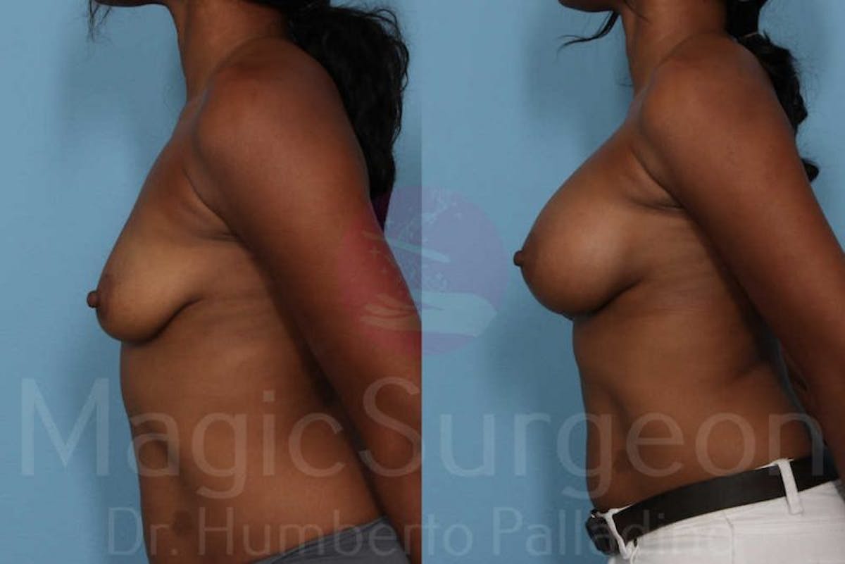 Breast Augmentation Before & After Gallery - Patient 133182436 - Image 3