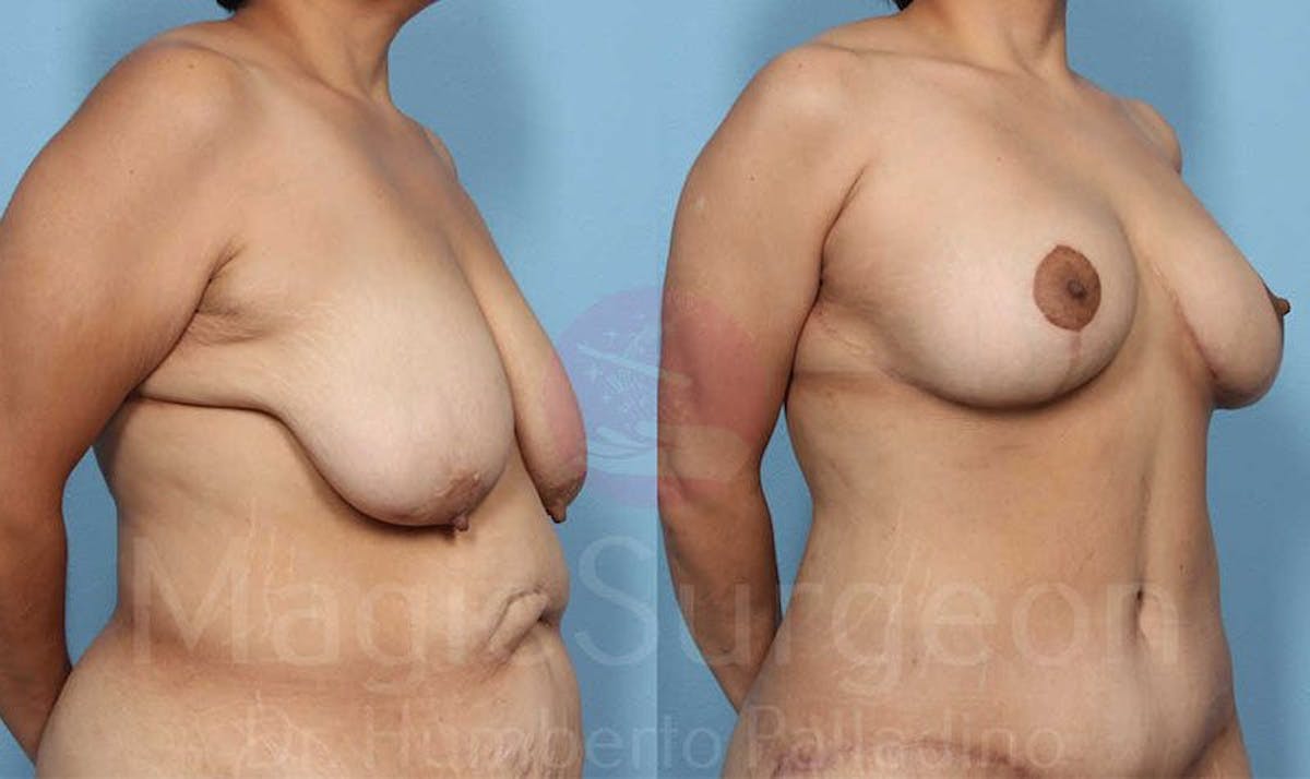 Breast Lift Before & After Gallery - Patient 133182438 - Image 2