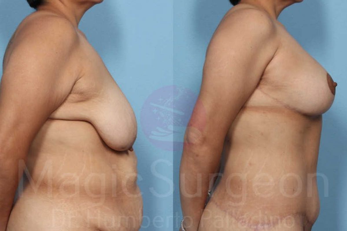Breast Lift Before & After Gallery - Patient 133182438 - Image 3