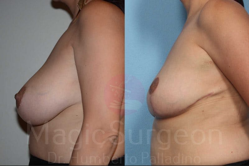 Breast Reduction Before & After Gallery - Patient 133182440 - Image 3