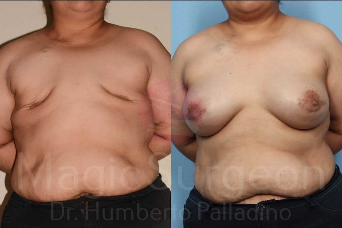 Breast Reconstruction Before & After Gallery - Patient 133182439 - Image 1