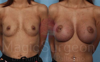 Breast Augmentation Before & After Gallery - Patient 133182441 - Image 1